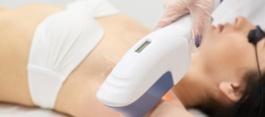 laser hair removal